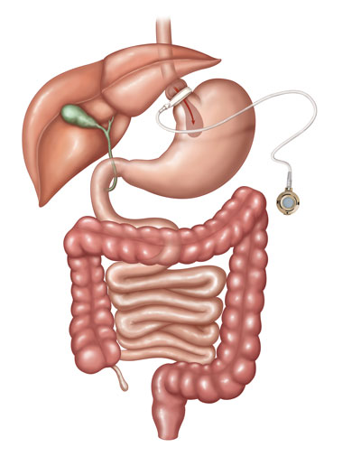 Gastric band illustration