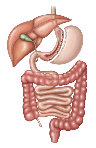 Sleeve gastrectomy illustration